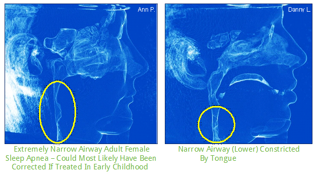 Airway narrow.jpg